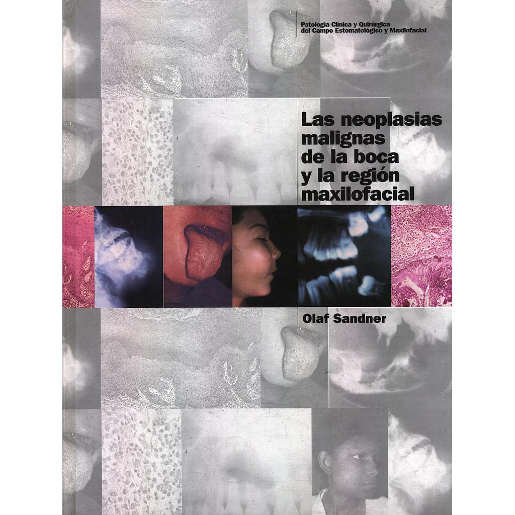Las neoplasias malignas de la boca y la región maxilofacial